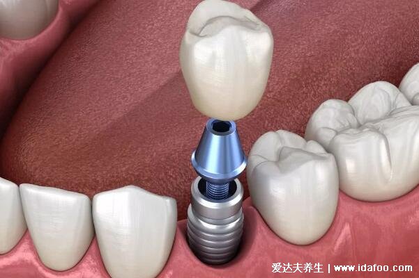 种植牙有什么风险和后遗症，为什么良心医生不建议种植牙