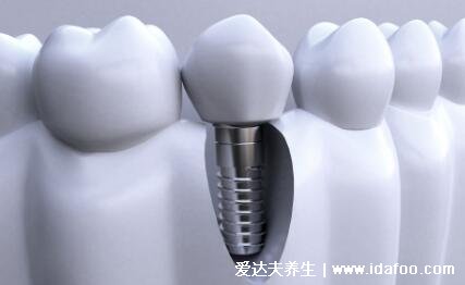 种植牙有什么风险和后遗症，五大坏处影响口腔(谨慎种植)