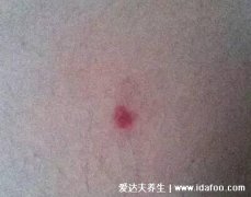 朱砂痣的图片是什么样子，无害的红色痣(与
