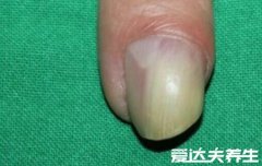 最轻微的灰指甲图片展示,你中招了吗(史上