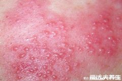 100种皮肤病对照表，警惕常见皮肤病类型(水