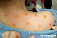 艾灸后怎么看湿气排出，有出汗/长红疹/放臭