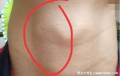 艾滋病性颈淋巴结肿大图片，警惕颈部/腋下