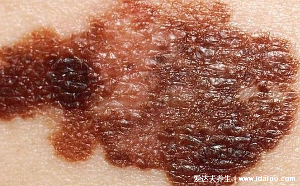 癌症前期的18种预兆和图片,常见的乳腺癌/胃癌/肝癌症状合集