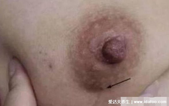 癌症前期的18种预兆和图片,常见的乳腺癌/胃癌/肝癌症状合集