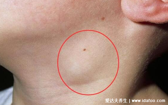 癌症前期的18种预兆和图片,常见的乳腺癌/胃癌/肝癌症状合集