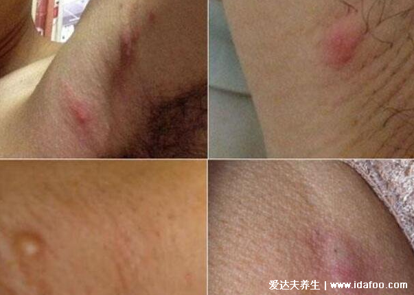 癌症前期的18种预兆和图片,常见的乳腺癌/胃癌/肝癌症状合集