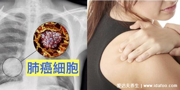 癌症前期的18种预兆和图片,常见的乳腺癌/胃癌/肝癌症状合集