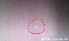 脖子上有白斑块图片，警惕贫血痣/花斑癣
