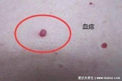 肝癌身上出现红点图片，血痣/蜘蛛痣可能是