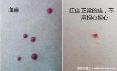 肝病的七个征兆，血痣/蜘蛛痣可能是严重肝