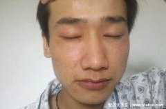 肝不好的人三黑两臭，脸黑/嘴唇黑/指甲黑