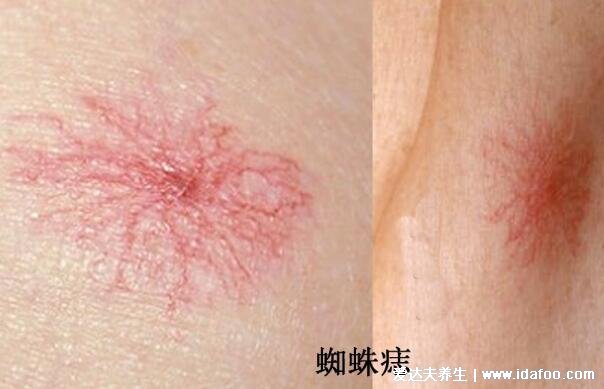 肝病早期可能有6个征兆,持续低热/乏力/食欲减退是常见症状