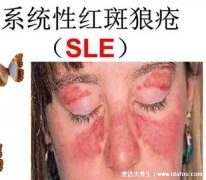 红斑狼疮早期10个征兆,面部蝶形红斑/口腔