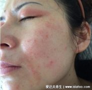 红斑狼疮早期10个征兆图片,脸上长蝴蝶形红