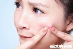 红霉素软膏的作用及功能,有效治疗痘痘/脓