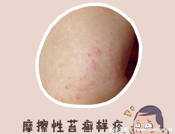 过敏和疹子的区别图片,过敏可引起湿疹/荨麻疹(各种疹子的症状图片)