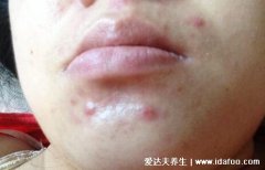 疖肿早期图片，火疖子/毒疖子成熟的图片