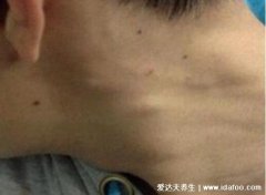 淋巴癌的早期症状和前兆图片，警惕颈部/腋