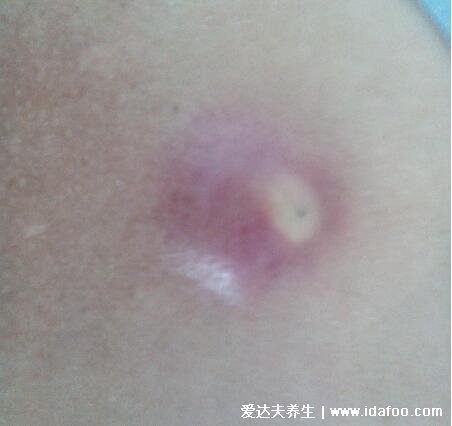 疖肿早期图片,火疖子/毒疖子成熟的图片(毛囊感染导致红肿化脓)