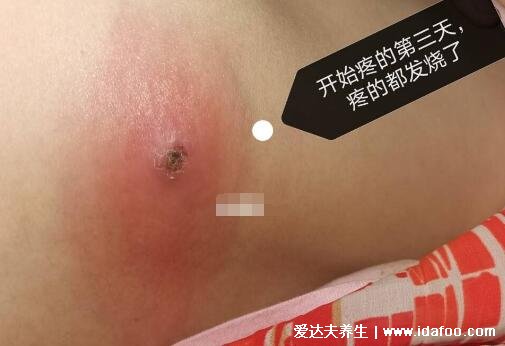 疖肿早期图片,火疖子/毒疖子成熟的图片(毛囊感染导致红肿化脓)
