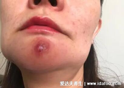 疖肿早期图片,火疖子/毒疖子成熟的图片(毛囊感染导致红肿化脓)