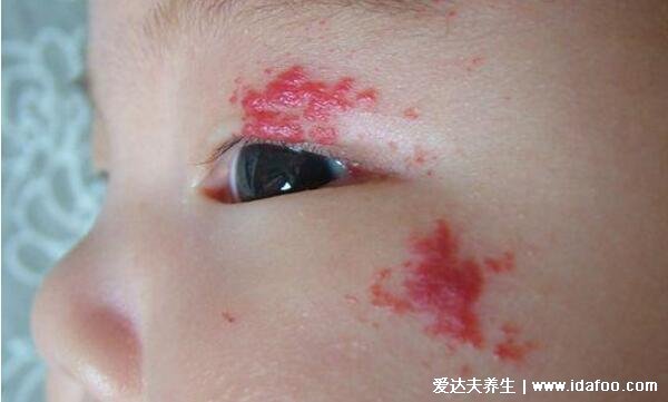 良性皮肤瘤有哪几种图片及症状,色素痣/先天性血管瘤/瘢痕疙瘩