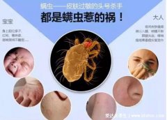 螨虫过敏症状图片，可打喷嚏等似感冒/被咬