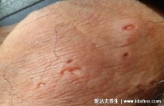 男女得性疾病前兆的图片，梅毒/尖锐湿疣