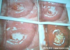 男女尖湿锐尤典型早期图片，皆呈现菜花/鸡