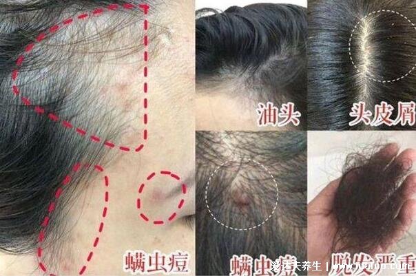 螨虫的克星是什么,怎么判断床上有螨虫图片(阳光/高温杀死螨虫)