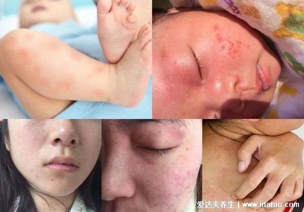 螨虫的克星是什么,怎么判断床上有螨虫图片(阳光/高温杀死螨虫)