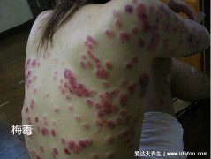 男性得性疾病后八大症状，警惕梅毒/生殖器