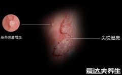 男性尖锐湿尤图初期图片，生殖器周围长菜