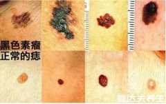 皮肤癌早期症状图片,出现不正常的痣/新生