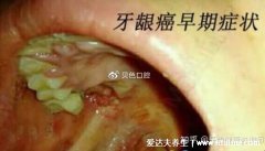 牙龈癌的早期三大症状，注意病程极长口腔