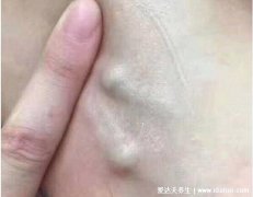 腋下淋巴癌早期图片症状，警惕腋窝有不痛