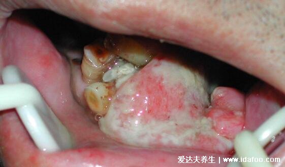 牙龈癌的早期三大症状,口腔溃疡/牙齿松动/长菜花样的肿物