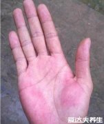 真实的肝掌图片,出现肝掌/蜘蛛痣说明患有