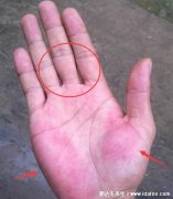 真实的肝掌图片高清图片,肝掌/蜘蛛痣可能