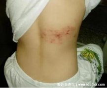 治疗缠腰瘤的民间偏方,仙人掌/蒲公英都能