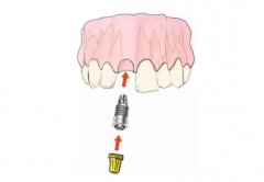 种植牙有什么风险和后遗症，可能导致神经