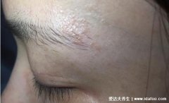 5种普通皮癣早期图片及症状,轻度面癣/手癣