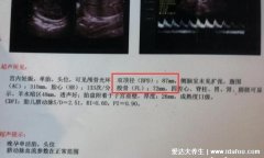 B超单3个数据看男女,用双顶径和股骨长/孕