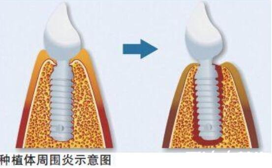 种植牙有什么风险和后遗症,可能导致神经紊乱/牙龈萎缩