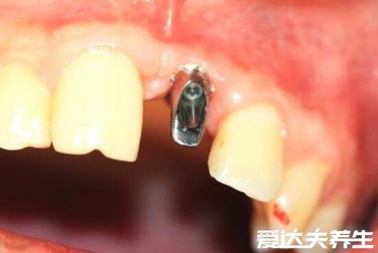 种植牙有什么风险和后遗症,可能导致神经紊乱/牙龈萎缩