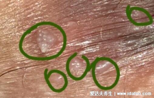 hpv是什么病毒图片,真实女性hpv病毒初期图(寻常疣/宫颈癌)