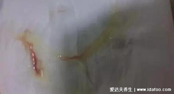 hpv是什么病毒图片,真实女性hpv病毒初期图(寻常疣/宫颈癌)