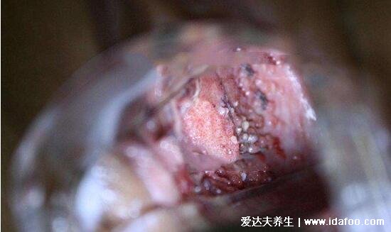 hpv是什么病毒图片,真实女性hpv病毒初期图(寻常疣/宫颈癌)