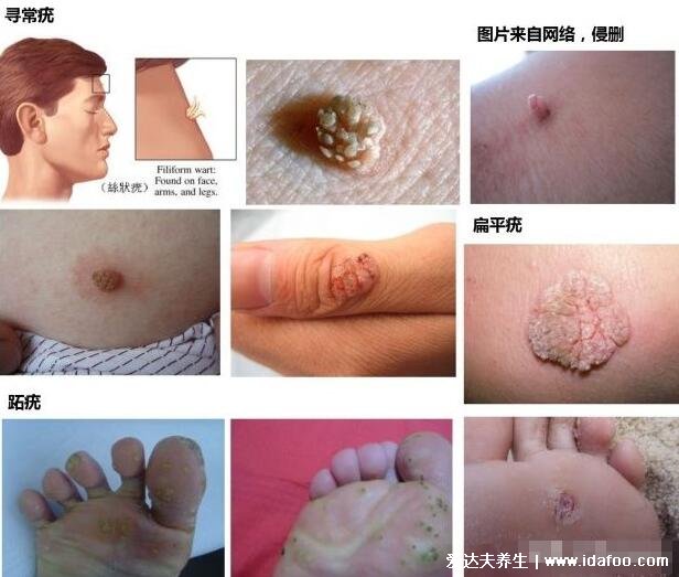 hpv是什么病毒图片,真实女性hpv病毒初期图(寻常疣/宫颈癌)